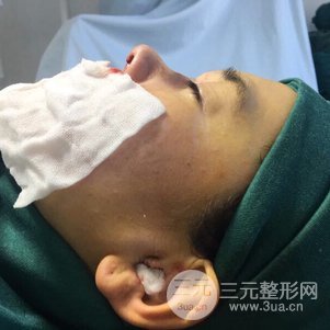 隆鼻整形多少錢 南京克拉美隆鼻整形案例