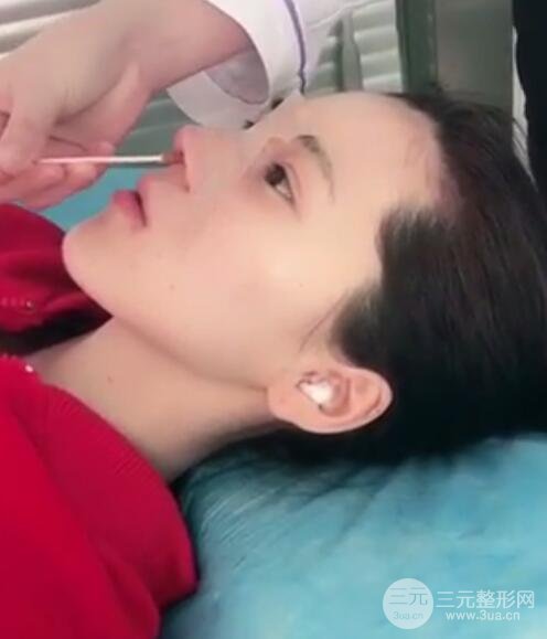 隆鼻整形多少錢 南京克拉美隆鼻整形案例