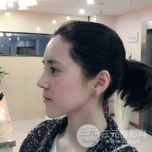 隆鼻整形多少錢 南京克拉美隆鼻整形案例