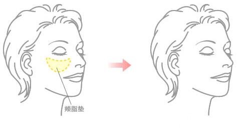 去頰脂墊果怎么樣 取頰脂墊手術(shù)前后對比照片