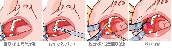 去頰脂墊果怎么樣 取頰脂墊手術(shù)前后對比照片
