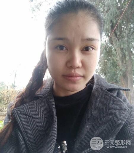 鼻頭縮小術(shù)過(guò)程圖，鼻頭縮小恢復(fù)日記