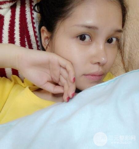 鼻頭縮小術(shù)過(guò)程圖，鼻頭縮小恢復(fù)日記