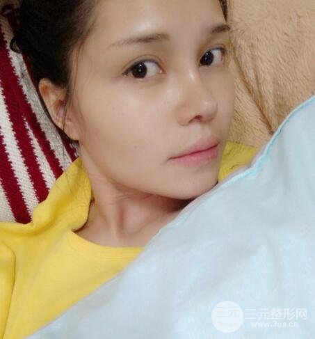 鼻頭縮小術(shù)過(guò)程圖，鼻頭縮小恢復(fù)日記