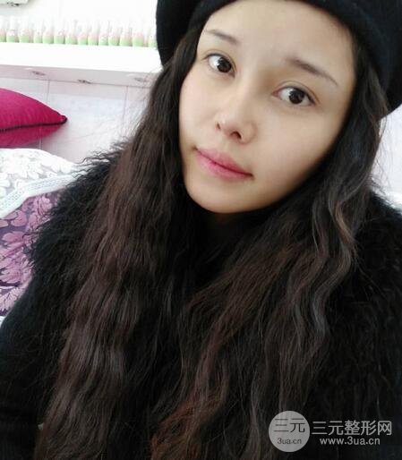 鼻頭縮小術(shù)過(guò)程圖，鼻頭縮小恢復(fù)日記