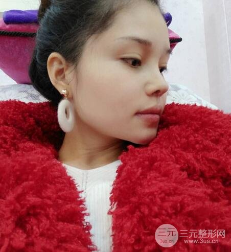 鼻頭縮小術(shù)過(guò)程圖，鼻頭縮小恢復(fù)日記