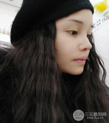 鼻頭縮小術(shù)過(guò)程圖，鼻頭縮小恢復(fù)日記