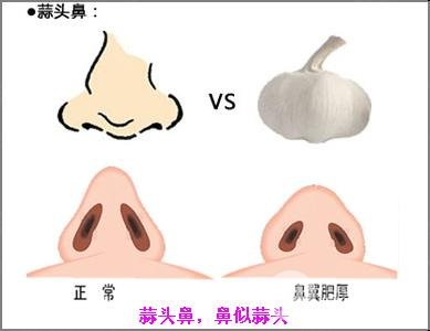 蒜頭鼻矯正