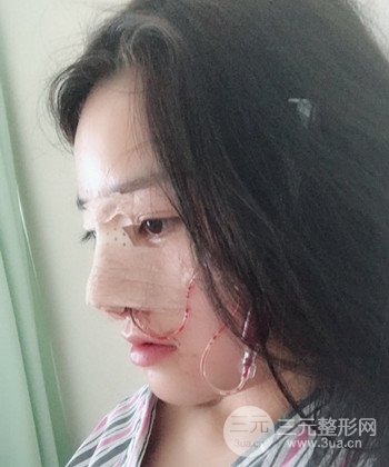 達(dá)拉斯綜合隆鼻后對(duì)比照片，顏值提高不是夢(mèng)