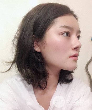 達(dá)拉斯綜合隆鼻后對(duì)比照片，顏值提高不是夢(mèng)