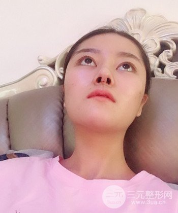 達(dá)拉斯綜合隆鼻后對(duì)比照片，顏值提高不是夢(mèng)