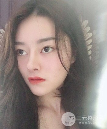 達(dá)拉斯綜合隆鼻后對(duì)比照片，顏值提高不是夢(mèng)