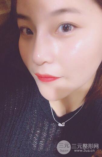 隆鼻鼻翼縮小全過(guò)程和術(shù)后照片分享,隨意揉捏很OK
