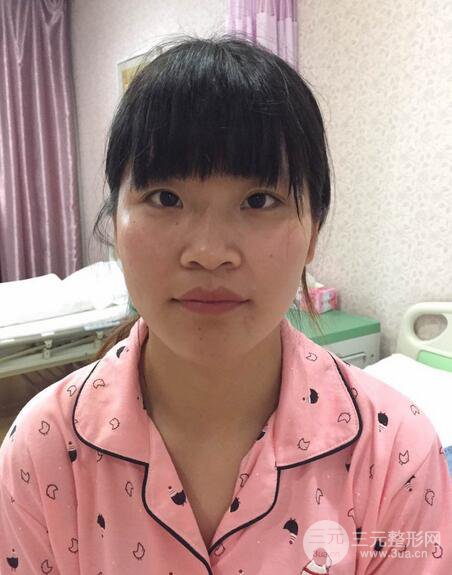 隆鼻鼻翼縮小全過(guò)程和術(shù)后照片分享,隨意揉捏很OK