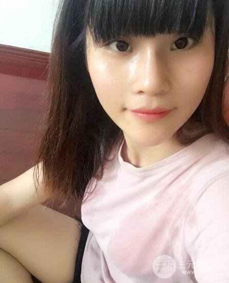 隆鼻鼻翼縮小全過(guò)程和術(shù)后照片分享,隨意揉捏很OK