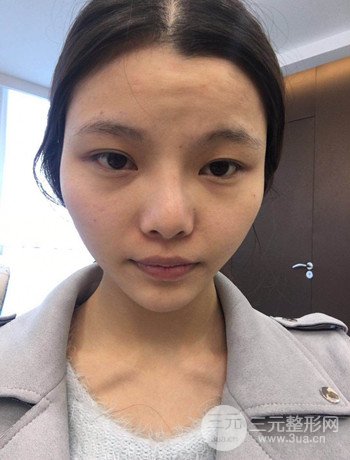 全臉自體脂肪填充+隆鼻整形果永.久保持、丑小鴨變天鵝不是夢(mèng)