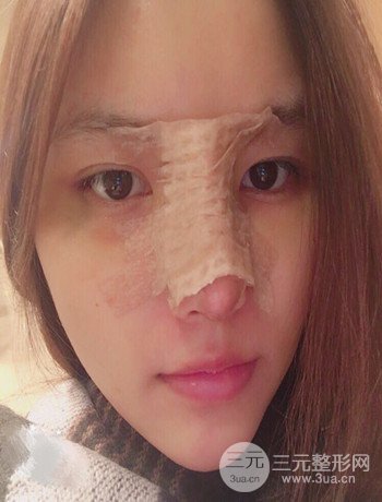 全臉自體脂肪填充+隆鼻整形果永.久保持、丑小鴨變天鵝不是夢(mèng)