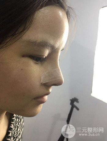 全臉自體脂肪填充+隆鼻整形果永.久保持、丑小鴨變天鵝不是夢(mèng)