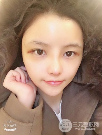 全臉自體脂肪填充+隆鼻整形果永.久保持、丑小鴨變天鵝不是夢(mèng)