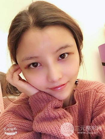 全臉自體脂肪填充+隆鼻整形果永.久保持、丑小鴨變天鵝不是夢(mèng)