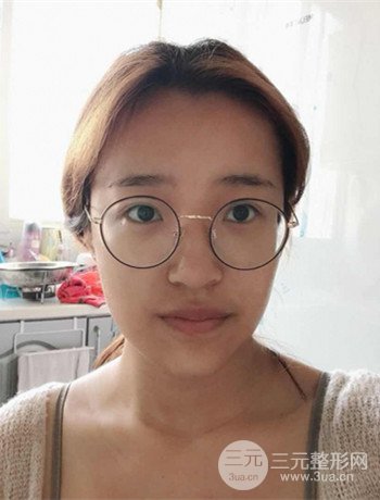 上海面部脂肪填充一個(gè)月果超明X、妥妥減齡十歲！