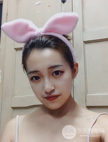 上海面部脂肪填充一個(gè)月果超明X、妥妥減齡十歲！