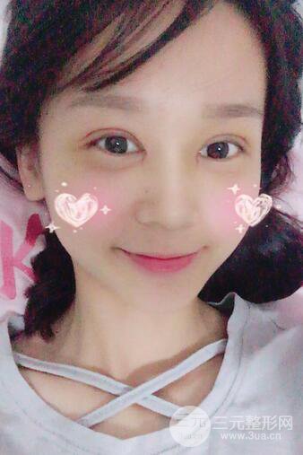 芭比電雙眼皮多項整形術(shù)后分享,雙眼皮拯救死魚眼!