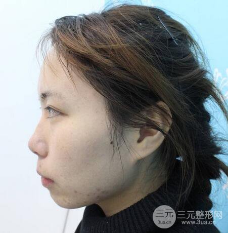 自體脂肪填充全臉基本換臉，改臉型不只是磨骨才能做到！