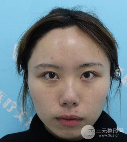 自體脂肪填充全臉基本換臉，改臉型不只是磨骨才能做到！