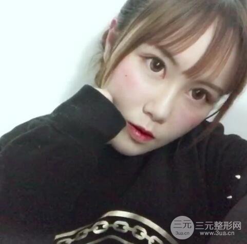 自體脂肪填充全臉基本換臉，改臉型不只是磨骨才能做到！