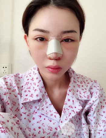 上海隆鼻失敗手術(shù)修復(fù)果超乎想象、前后對比照片分享