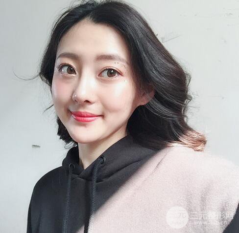 肋軟骨隆鼻+歪鼻矯正案例