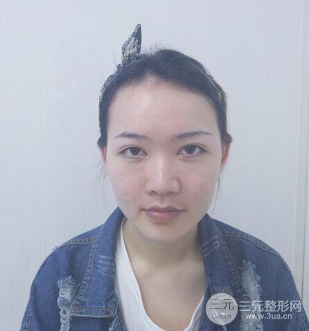 耳軟骨隆鼻全過程及術(shù)后果分享