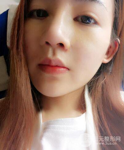 耳軟骨隆鼻全過程及術(shù)后果分享