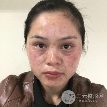 廣州激光祛雀斑果不反彈、恢復(fù)過程圖片分享