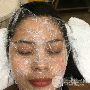 廣州激光祛雀斑果不反彈、恢復(fù)過程圖片分享