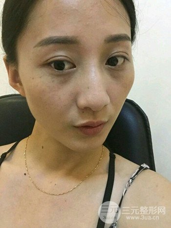 朱彤玥激光祛斑案例、兩個月果對比超明X