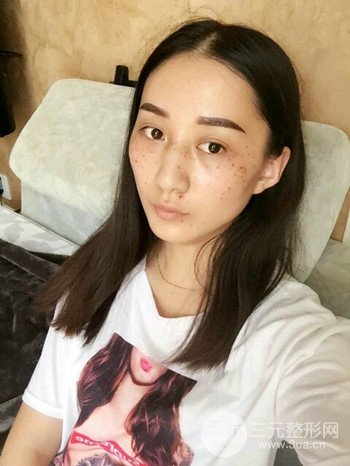 朱彤玥激光祛斑案例、兩個月果對比超明X