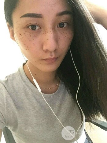 朱彤玥激光祛斑案例、兩個月果對比超明X