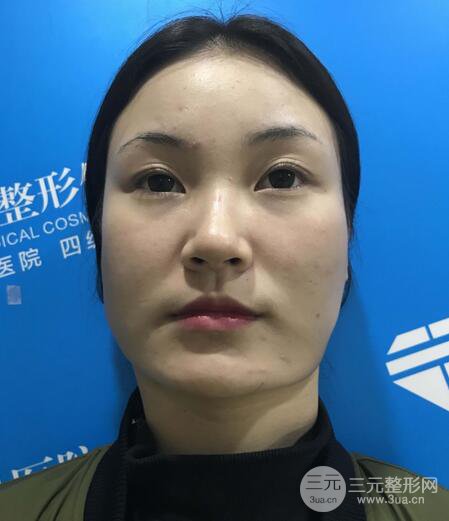 下頜角磨骨整形全過程分享，附上術后恢復照片~