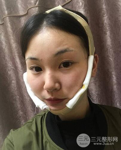 下頜角磨骨整形全過程分享，附上術后恢復照片~