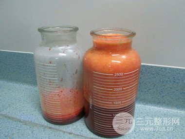大腿抽脂果好到不行、瘦十厘米不是問(wèn)題
