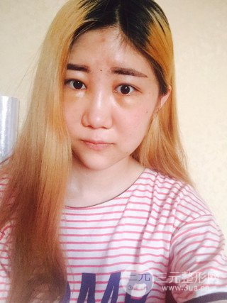 深圳臻希美詳細(xì)部自體脂肪填充果對(duì)比超明X