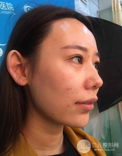 全臉自體脂肪填充,填充不飽滿還可以瘦臉_真人案例