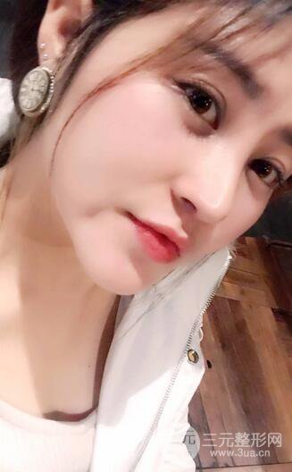 膨體隆鼻術(shù)后恢復(fù)果圖_全過程解密