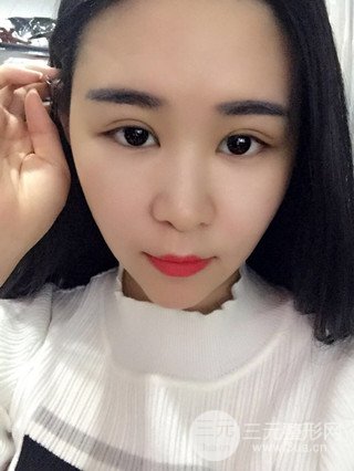 深圳全切雙眼皮修復(fù)成功案例恢復(fù)過程分享