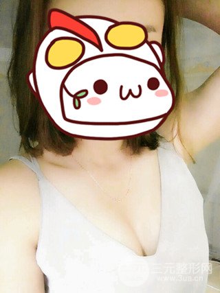 賈維順假體隆胸三個月果圖|立現(xiàn)傲人上圍