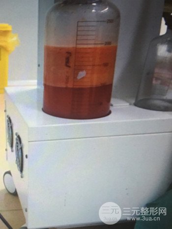 濟南腰腹吸脂案例三個月前后變化圖片分享