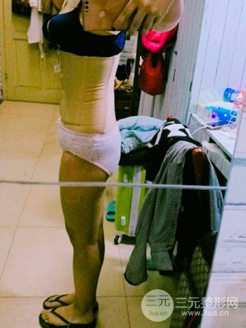 濟南腰腹吸脂案例三個月前后變化圖片分享