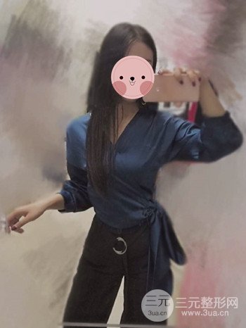 濟南腰腹吸脂案例三個月前后變化圖片分享